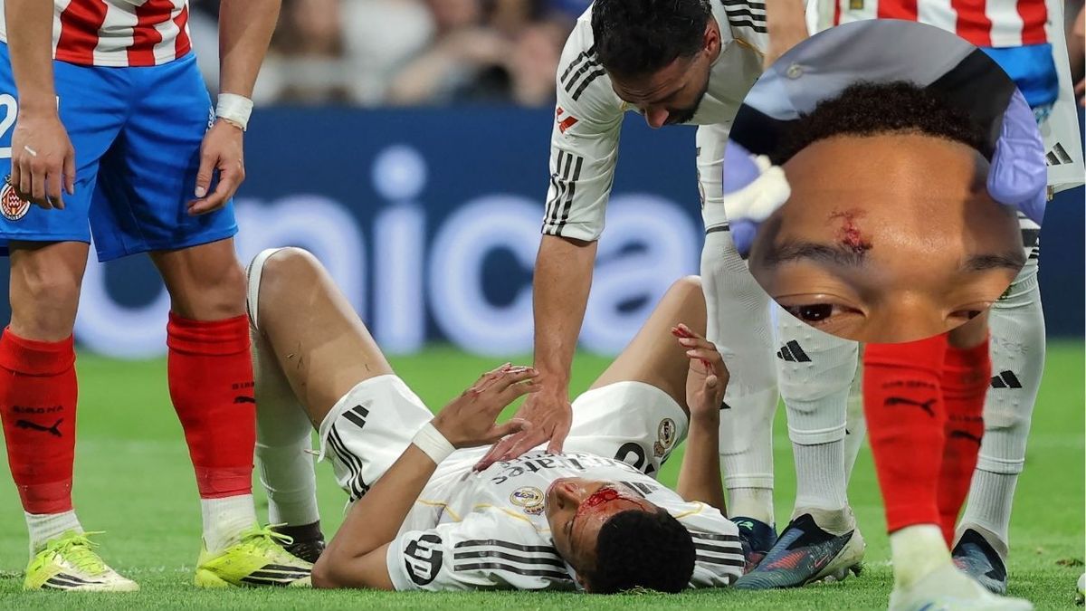 Mbappé sufrió corte en la ceja