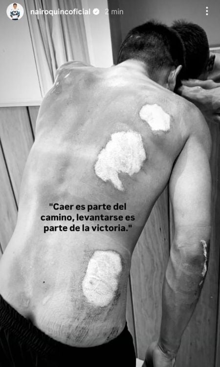 Heridas de Nairo Quintana