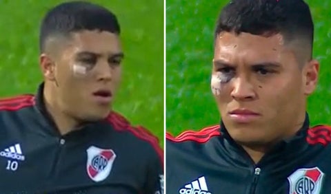 Golpe en el ojo de Juanfer Quintero