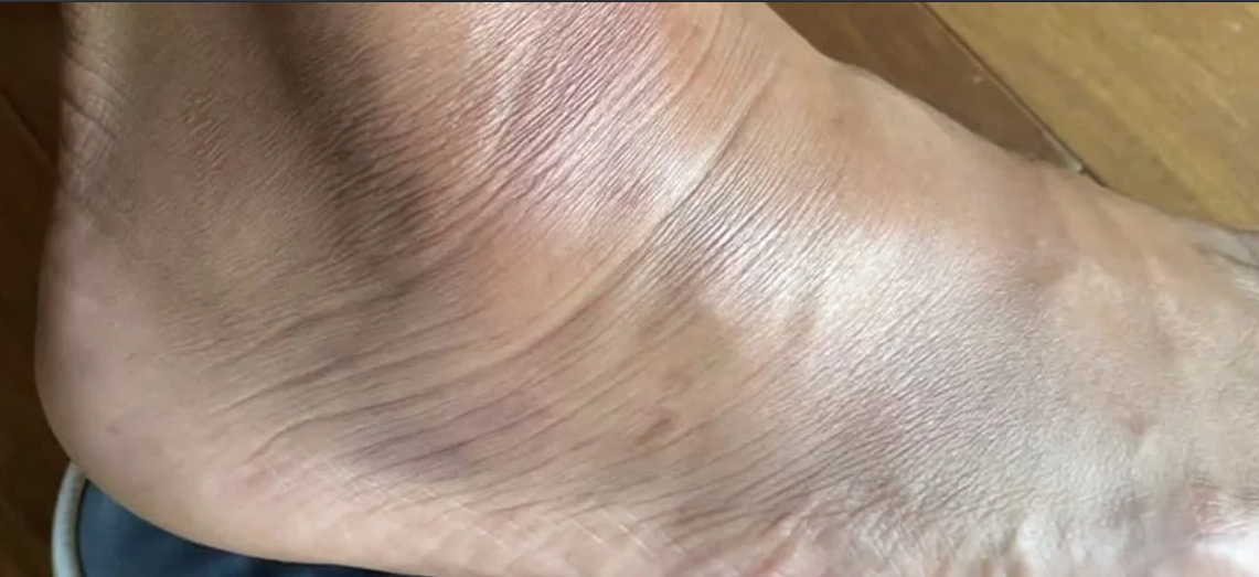 Captura de pantalla del tobillo de Carlos Tévez